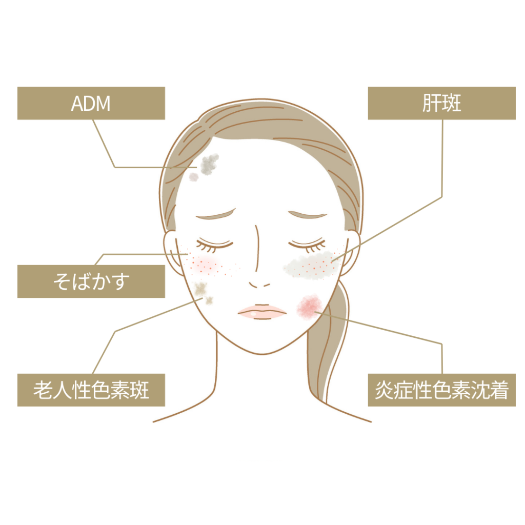 複数のシミが示された女性のイラスト