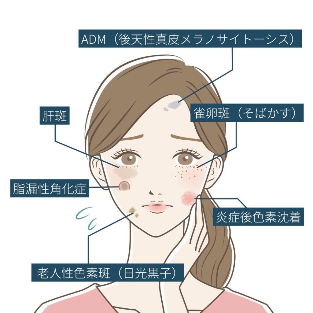 複数のシミが示された女性のイラスト
