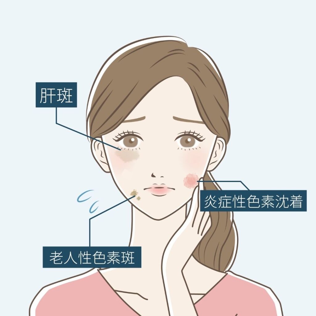 40代に多いシミの種類の図解